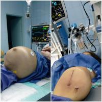 جراحی طحال بزرگ