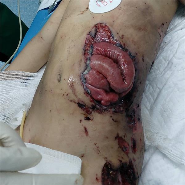 جراحی اورژانسی یک کودک 2 ساله در اثر انفجار بنزین در منزل